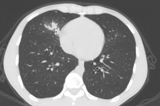 4、肺部CT显示患者右肺中叶炎症.jpg