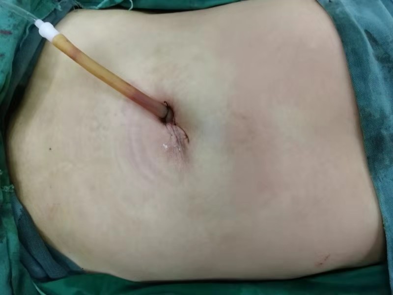 1、经脐单孔腹腔镜微创手术，患者腹部不见疤.jpg