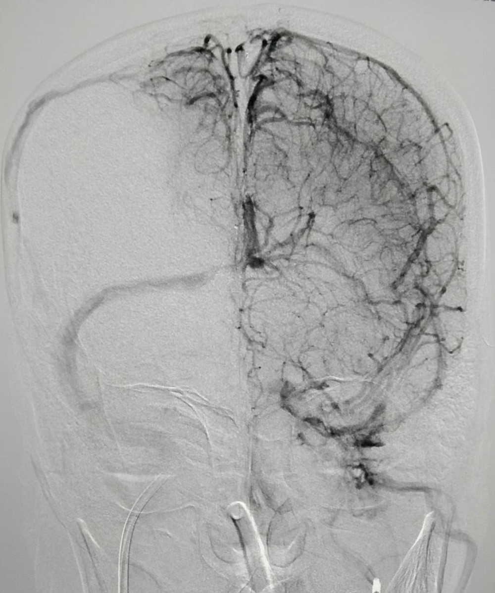 1、覃先生右侧的颅内静脉、上矢状窦、窦汇始终不显影.jpg