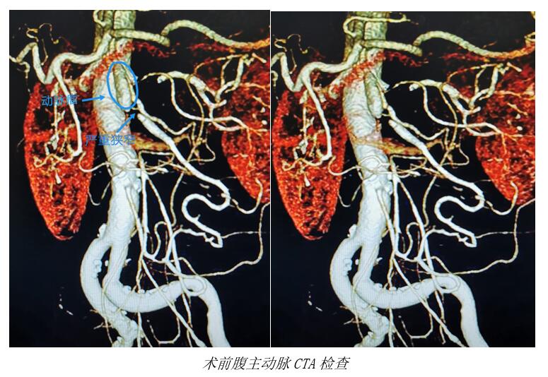 腹主动脉影像解剖图图片
