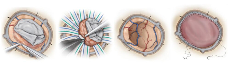 3脑膜瘤手术示意图.jpg